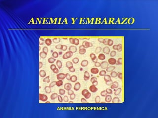 ANEMIA Y EMBARAZO
ANEMIA FERROPENICA
 