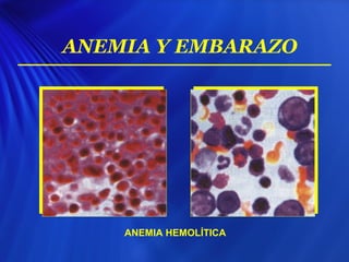 ANEMIA Y EMBARAZO
ANEMIA HEMOLÍTICA
 