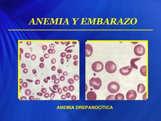 ANEMIA Y EMBARAZO
ANEMIA DREPANOCÍTICA
 