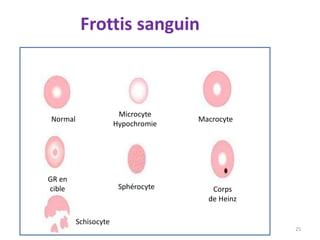 25
Normal
Sphérocyte
Microcyte
Hypochromie
Macrocyte
GR en
cible Corps
de Heinz
Schisocyte
Frottis sanguin
 