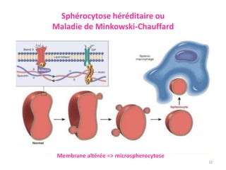 Sphérocytose héréditaire ou
Maladie de Minkowski-Chauffard
32
Membrane altérée => microspherocytose
 