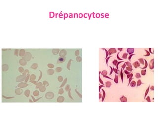 Drépanocytose
 