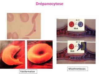 Drépanocytose
Falciformation
Micothromboses
 