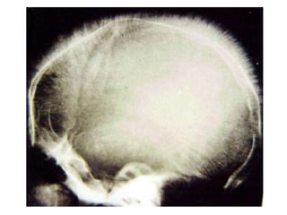 aspect en poils de brosse
 