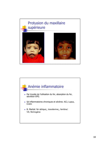 Protusion du maxillaire
 supérieure




 Anémie inflammatoire
Par trouble de l’utilisation du fer, absorption du fer,
sécrétion EPO.

Sd inflammatoires chroniques et sévères: ACJ, Lupus,
Crohn

B. Martial: fer sérique↓, transferrine↓, ferritine↑
VS, fibrinogène




                                                          18
 