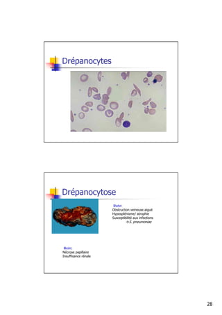 Drépanocytes




Drépanocytose
                       Rate:
                      Obstruction veineuse aiguë
                      Hyposplénisme/ atrophie
                      Susceptibilité aux infections
                                 S. pneumoniae




 Rein:
Nécrose papillaire
Insuffisance rénale




                                                      28
 