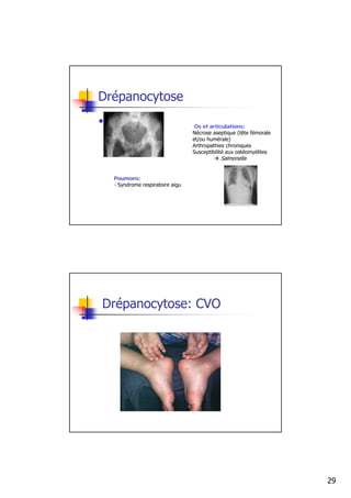 Drépanocytose

                                  Os et articulations:
                                 Nécrose aseptique (tête fémorale
                                 et/ou humérale)
                                 Arthropathies chroniques
                                 Susceptibilité aux ostéomyélites
                                            Salmonella


  Poumons:
  - Syndrome respiratoire aigu




Drépanocytose: CVO




                                                                    29
 