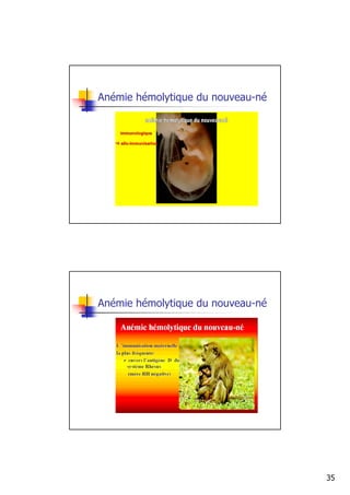 Anémie hémolytique du nouveau-né




Anémie hémolytique du nouveau-né




                                   35
 