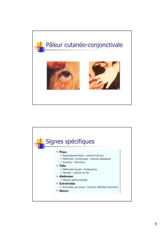 Pâleur cutanéo-conjonctivale




Signes spécifiques




                               5
 