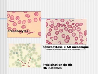 
drépanocytes
Schizocytose = AH mécanique
Précipitation de Hb
Hb instables
 