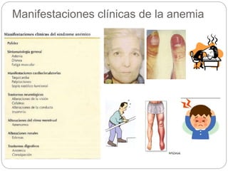Manifestaciones clínicas de la anemia
 