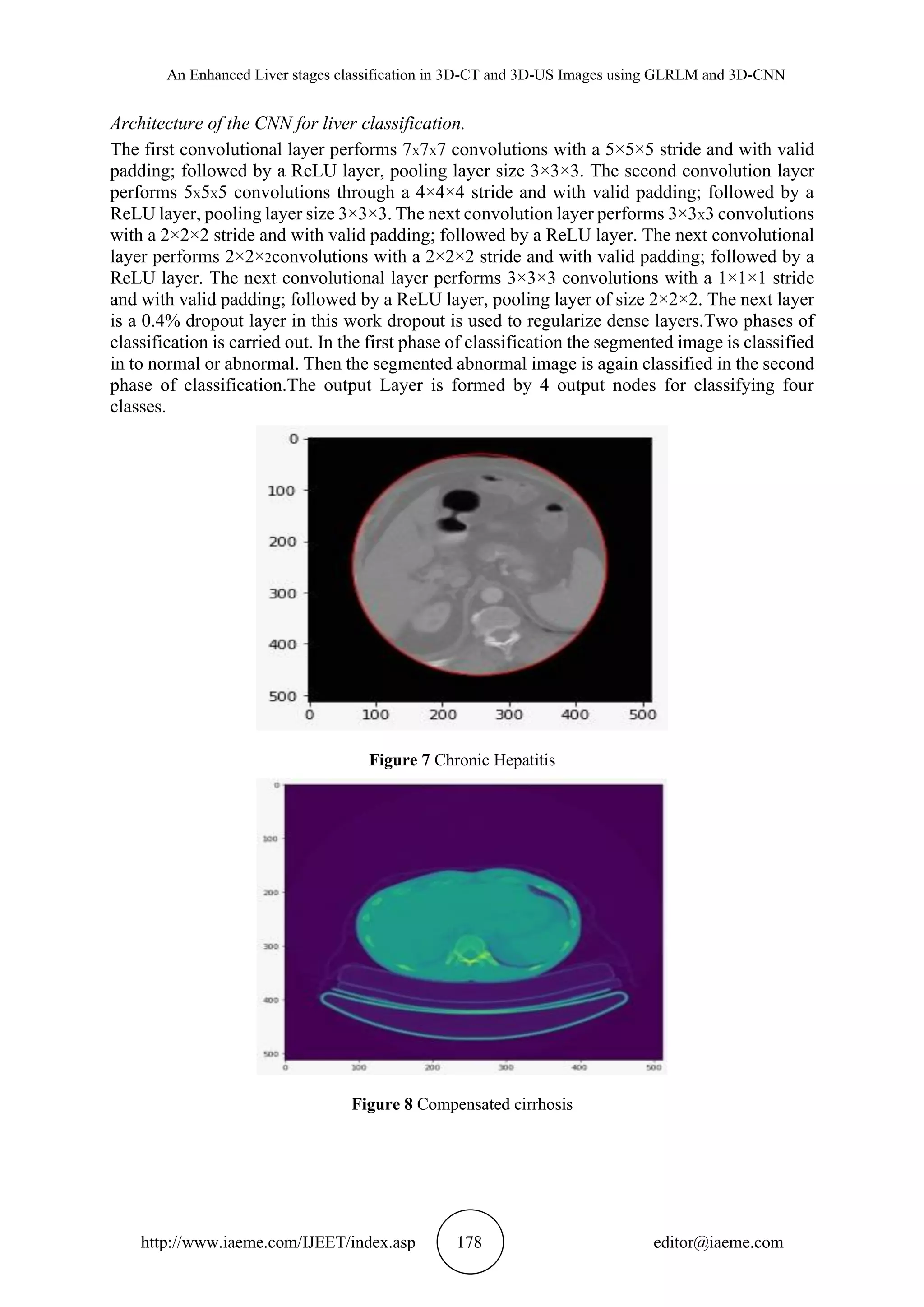 An Enhanced Liver stages classification in 3D-CT and 3D-US Images using GLRLM and 3D-CNN
http://www.iaeme.com/IJEET/index.asp 178 editor@iaeme.com
Architecture of the CNN for liver classification.
The first convolutional layer performs 7X7X7 convolutions with a 5×5×5 stride and with valid
padding; followed by a ReLU layer, pooling layer size 3×3×3. The second convolution layer
performs 5X5X5 convolutions through a 4×4×4 stride and with valid padding; followed by a
ReLU layer, pooling layer size 3×3×3. The next convolution layer performs 3×3X3 convolutions
with a 2×2×2 stride and with valid padding; followed by a ReLU layer. The next convolutional
layer performs 2×2×2convolutions with a 2×2×2 stride and with valid padding; followed by a
ReLU layer. The next convolutional layer performs 3×3×3 convolutions with a 1×1×1 stride
and with valid padding; followed by a ReLU layer, pooling layer of size 2×2×2. The next layer
is a 0.4% dropout layer in this work dropout is used to regularize dense layers.Two phases of
classification is carried out. In the first phase of classification the segmented image is classified
in to normal or abnormal. Then the segmented abnormal image is again classified in the second
phase of classification.The output Layer is formed by 4 output nodes for classifying four
classes.
Figure 7 Chronic Hepatitis
Figure 8 Compensated cirrhosis
 