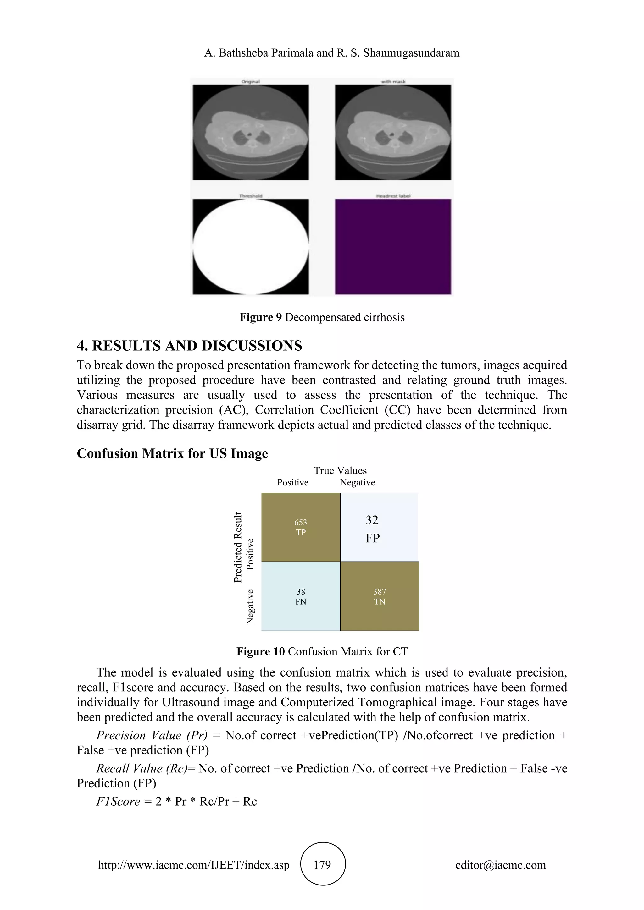 A. Bathsheba Parimala and R. S. Shanmugasundaram
http://www.iaeme.com/IJEET/index.asp 179 editor@iaeme.com
Figure 9 Decompensated cirrhosis
4. RESULTS AND DISCUSSIONS
To break down the proposed presentation framework for detecting the tumors, images acquired
utilizing the proposed procedure have been contrasted and relating ground truth images.
Various measures are usually used to assess the presentation of the technique. The
characterization precision (AC), Correlation Coefficient (CC) have been determined from
disarray grid. The disarray framework depicts actual and predicted classes of the technique.
Confusion Matrix for US Image
Predicted
Result
Negative
Positive
True Values
Positive Negative
653
TP
32
FP
38
FN
387
TN
Figure 10 Confusion Matrix for CT
The model is evaluated using the confusion matrix which is used to evaluate precision,
recall, F1score and accuracy. Based on the results, two confusion matrices have been formed
individually for Ultrasound image and Computerized Tomographical image. Four stages have
been predicted and the overall accuracy is calculated with the help of confusion matrix.
Precision Value (Pr) = No.of correct +vePrediction(TP) /No.ofcorrect +ve prediction +
False +ve prediction (FP)
Recall Value (Rc)= No. of correct +ve Prediction /No. of correct +ve Prediction + False -ve
Prediction (FP)
F1Score = 2 * Pr * Rc/Pr + Rc
 