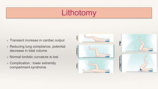 Lithotomy
❖ Transient increase in cardiac output
❖ Reducing lung compliance, potential
decrease in tidal volume
❖ Normal lordotic curvature is lost
❖ Complication : lower extremity
compartment syndrome
 