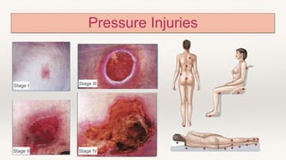 Pressure Injuries
Stage I
Stage II
Stage III
Stage IV
 