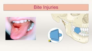 Bite Injuries
 