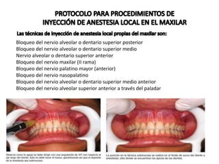 anestecias odontologia.pptx