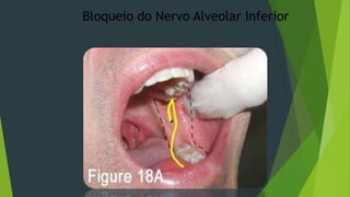 Bloqueio do Nervo Alveolar Inferior

 