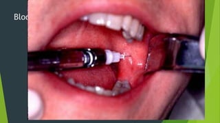 Bloqueio do Nervo Alveolar Inferior

 