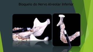 Bloqueio do Nervo Alveolar Inferior

 