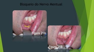 Bloqueio do Nervo Mentual

 