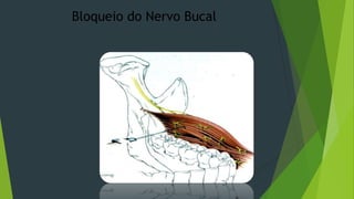 Bloqueio do Nervo Bucal

 