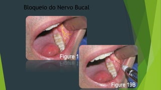 Bloqueio do Nervo Bucal

 