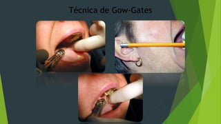 Técnica de Gow-Gates

 