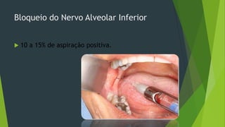 Bloqueio do Nervo Alveolar Inferior


10 a 15% de aspiração positiva.

 