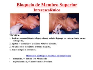 Bloqueio de Membro Superior
Interescalênico
TÉCNICA:
1. Paciente em decubito dorsal com o braço ao lado do corpo e a cabeça virada para o
lado oposto,
2. Apalpa-se os músculos escalenos Anterior e Médio,
3. Na fenda inter escalênica, introduz a agulha,
4. Aspira e injeta o anestésico.
Medicações usadas para Anestesia Interescalênico:
• Lidocaina 2% com ou sem Adrenalina
• Bupivacaina a 0,5% com ou sem Adrenalina
 