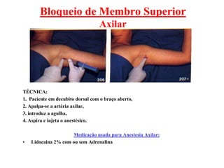 Bloqueio de Membro Superior
Axilar
TÉCNICA:
1. Paciente em decubito dorsal com o braço aberto,
2. Apalpa-se a artéria axilar,
3. introduz a agulha,
4. Aspira e injeta o anestésico.
Medicação usada para Anestesia Axilar:
• Lidocaina 2% com ou sem Adrenalina
 