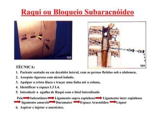 Raqui ou Bloqueio Subaracnóideo
TÉCNICA:
1. Paciente sentado ou em decubito lateral, com as pernas fletidas sob o abdomen,
2. Assepsia rigorosa com alcool iodado,
3. Apalpar a crista ilíaca e traçar uma linha até a coluna,
4. Identificar o espaço L3 L4,
5. Introduzir a agulha de Raqui com o bisel lateralizado
Pele Subcutâneo Ligamento supra espinhoso Ligamento inter espinhoso
ligamento amarelo Duramater Espaço Aracnóideo Liquor
6. Aspirar e injetar o anestésico.
 