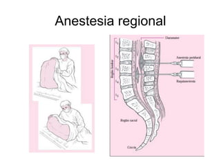 Anestesia regional
 