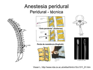 Anestesia peridural
Peridural - técnica
Visser L. http://www.nda.ox.ac.uk/wfsa/html/u13/u1311_01.htm
Perda de resistência (Dogliotti)
“Gota pendente” (Gutierrez)
 