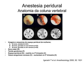 Anestesia peridural
Anatomia da coluna vertebral
• Imagens e esquemas do espaço peridural de mulheres:
A. 32 anos, saudável (n=21)
B. 29 anos, gravidez na 12ª semana (n=23)
C. 30 anos, gravidez na 30ª semana (n=29)
• Dura mater (D)
• Tecido gorduroso (F)
• Espaço peridural (S) – restrito no 3º trimestre (C)
• Vasos sanguíneos venosos (V) – aumentam no 3º trimestre (C)
Igarashi T et al. Anesthesiology 2000, 92: 1631
 
