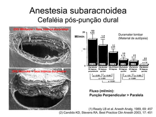 Anestesia subaracnoidea
Cefaléia pós-punção dural
(1) Ready LB et al. Anesth Analg, 1989, 69: 457
(2) Candido KD, Stevens RA. Best Practice Clin Anesth 2003, 17: 451
25G Whitacre – face interna duramater
25G Quincke – face interna duramater
Duramater lombar
(Material de autópsia)
Ml/min
Fluxo (ml/min):
Punção Perpendicular > Paralela
 