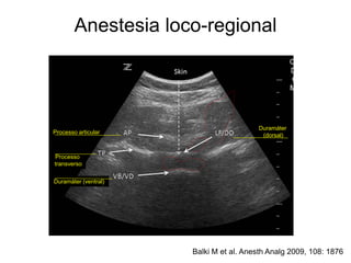 Anestesia loco-regional
Balki M et al. Anesth Analg 2009, 108: 1876
Processo articular
Processo
transverso
Duramáter
(dorsal)
Duramáter (ventral)
 
