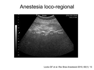 Locks GF et al. Rev Bras Anestesiol 2010, 60(1): 13
Anestesia loco-regional
 