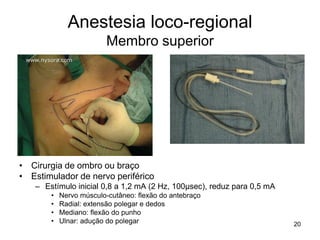 20
Anestesia loco-regional
Membro superior
• Cirurgia de ombro ou braço
• Estimulador de nervo periférico
– Estímulo inicial 0,8 a 1,2 mA (2 Hz, 100μsec), reduz para 0,5 mA
• Nervo músculo-cutâneo: flexão do antebraço
• Radial: extensão polegar e dedos
• Mediano: flexão do punho
• Ulnar: adução do polegar
 