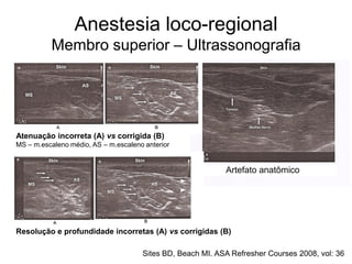 Anestesia loco-regional
Membro superior – Ultrassonografia
Artefato anatômico
Atenuação incorreta (A) vs corrigida (B)
MS – m.escaleno médio, AS – m.escaleno anterior
Resolução e profundidade incorretas (A) vs corrigidas (B)
Sites BD, Beach MI. ASA Refresher Courses 2008, vol: 36
 