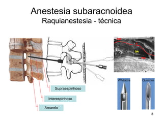8
Anestesia subaracnoidea
Raquianestesia - técnica
Supraespinhoso
Interespinhoso
Amarelo
DM
PM
A
SA
QuinckeWhitacre
 