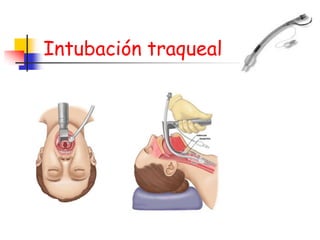 Intubación traqueal
 