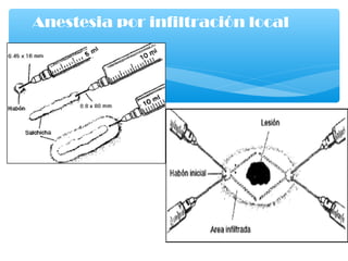 Anestesia por infiltración local
 