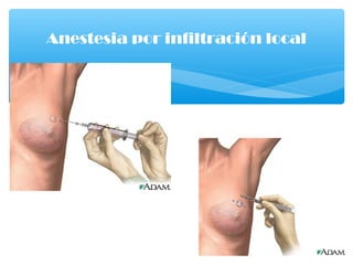 Anestesia por infiltración local
 