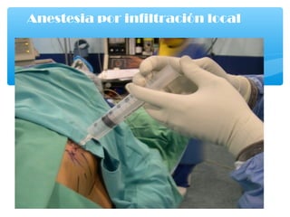 Anestesia por infiltración local
 