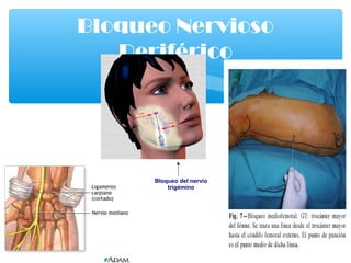 Bloqueo Nervioso
Periférico
Bloqueo del nervio
trigémino
 