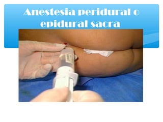 Anestesia peridural o
epidural sacra
 