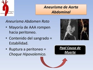 Aneurisma de Aorta
                        Abdominal

Aneurisma Abdomen Roto
• Mayoría de AAA rompen
  hacia peritoneo.
• Contenido del sangrado =
  Estabilidad.
• Ruptura a peritoneo =      Ppal Causa de
                                Muerte
  Choque Hipovolemico.
 