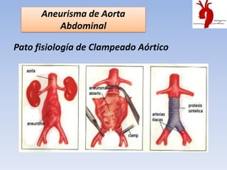 Aneurisma de Aorta
         Abdominal

Pato fisiología de Clampeado Aórtico
 
