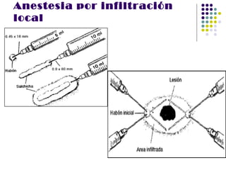 Anestesia por infiltración
local
 